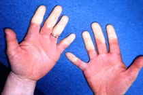 Những bệnh tật dễ trở nặng hơn trong mùa thu