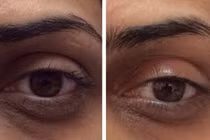 Cận cảnh quá trình bơm CO2 vào da trị quầng thâm mắt