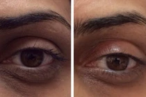 Cận cảnh quá trình bơm CO2 vào da trị quầng thâm mắt