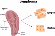 Có thể bị ung thư máu do phẫu thuật nâng ngực
