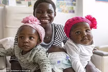 Cặp song sinh dính liền tự đi được sau phẫu thuật tách rời