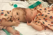 Ca tách rời triệu đô cho cặp sinh đôi dính liền đầu