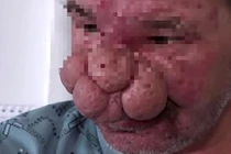 Khổ sở bao năm với “mũi sư tử” khổng lồ che nửa mặt