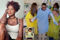 Nghịch dại với lửa và phải ghép da của người đã chết