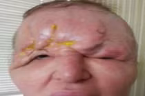 Quý bà xinh đẹp trông như quái vật vì dao kéo hỏng