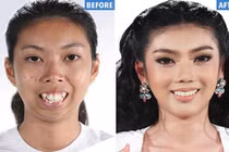 Giật mình hình ảnh trước dao kéo của hotgirl Thái Lan