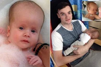 Bé sơ sinh đầu to quá khổ vì dị tật não