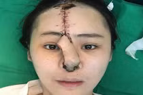 Cô gái xinh đẹp bị mất hẳn mũi vì ham làm đẹp 