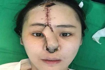 Cô gái xinh đẹp bị mất hẳn mũi vì ham làm đẹp 