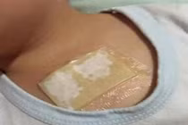 Mách mẹ làm túi gừng đắp ngực trị ho dứt điểm cho bé