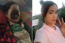 Thiếu nữ bị hủy hoại nửa khuôn mặt sau khi nhổ răng