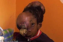 Bi kịch của cậu bé mạo hiểm tính mạng cắt u trên mặt