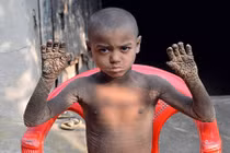 Sự hồi phục kỳ diệu của cậu bé người hóa đá 