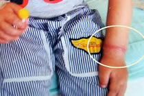 Bé 4 tuổi đeo chun vòng bị nghẽn mạch máu