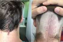 Ông bố tưởng bị chóng mặt phát hiện u não nhờ Facebook