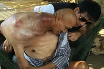 Nghị lực kiên cường củathầy giáo mang khối u to hơn đầu