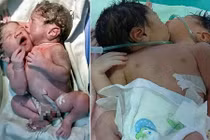 Cặp sinh đôi dính liền nụ hôn khiến các bác sỹ bó tay