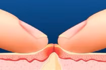 Đây là lý do bạn đừng bao giờ nặn mụn