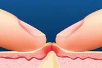 Đây là lý do bạn đừng bao giờ nặn mụn