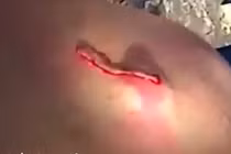 Mụn khổng lồ tuôn mủ vàng như suối trên lưng người đàn ông