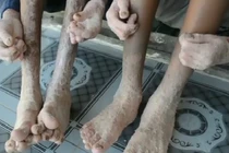 Cuộc sống cực hình của cha con người rắn ở Quảng Nam