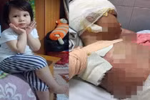 Cơ thể biến dạng của bé gái 5 tuổi bị bỏng cồn toàn thân