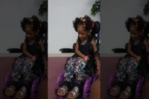 Cô bé 4 tuổi phải ngồi xe lăn cả đời sau khi nhổ răng