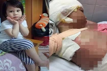 Cơ thể biến dạng của bé gái 5 tuổi bị bỏng cồn toàn thân