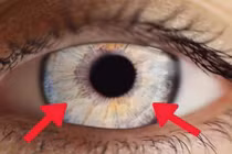 Dấu hiệu ở mống mắt cảnh báo sức khỏe có vấn đề