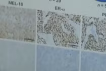 Tìm ra chìa khoá điều trị căn bệnh ung thư vú