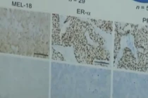 Tìm ra chìa khoá điều trị căn bệnh ung thư vú