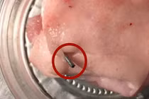 Hãi hùng phát hiện kim tiêm trong thịt lợn cung cấp cho trường học