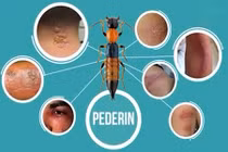 Bác sĩ gợi ý cách xử lý khi bị kiến ba khoang đốt