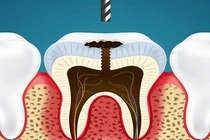 Xem cách nha sĩ nhổ răng sâu