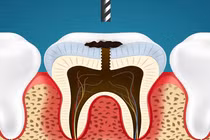 Xem cách nha sĩ nhổ răng sâu
