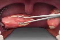 Cắt amidan nguy hiểm như thế nào?