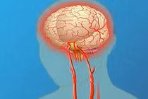 Những dấu hiệu nhận biết đột quỵ đơn giản