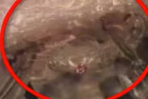 Kinh hoàng hàng trăm con rận mu bám trên mi mắt bé 6 tuổi