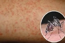 Điểm lại 5 dịch bệnh đáng sợ nhất ở Việt Nam