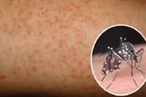 Điểm lại 5 dịch bệnh đáng sợ nhất ở Việt Nam