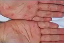 Biểu hiện và phòng tránh bệnh chân tay miệng