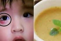 Mẹo đánh bay mụn lẹo tại nhà ngay lập tức
