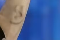 Người đàn ông có tai thứ 3 kỳ lạ trên cánh tay