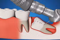 Tường tận cách loại bỏ răng khôn mọc lệch