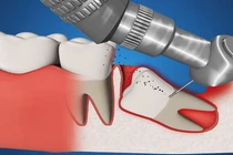 Tường tận cách loại bỏ răng khôn mọc lệch