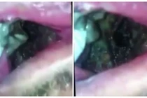 Khiếp đảm thứ đen sì lúc nhúc trong miệng người đàn ông