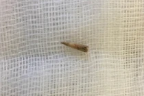 Cậu bé 15 tuổi suýt mất mạng vì gai bưởi