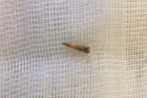 Cậu bé 15 tuổi suýt mất mạng vì gai bưởi