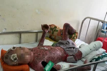 Hút thuốc gần bình xăng, nam thanh niên phải mổ 14 lần