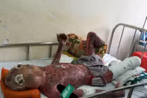 Hút thuốc gần bình xăng, nam thanh niên phải mổ 14 lần